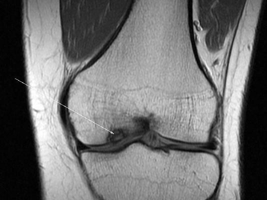 Durerea este cauzată de separarea cartilajului de osul condylelui interior al coapsei datorită necrozei avasculare