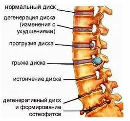 Behandling af ryggenes fremspring: skiver, cervikal, lumbal