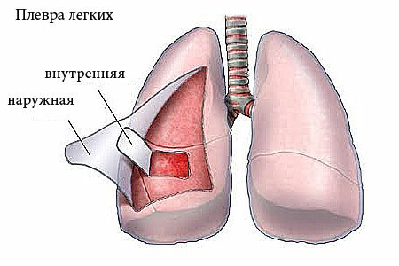 Pleurisia dos pulmões - formas, sintomas e tratamento
