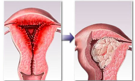 The risk of endometrial hyperplasia