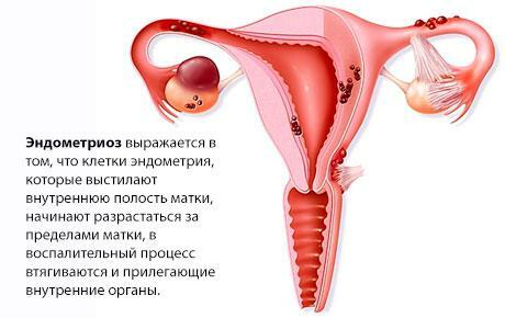 endometrióza