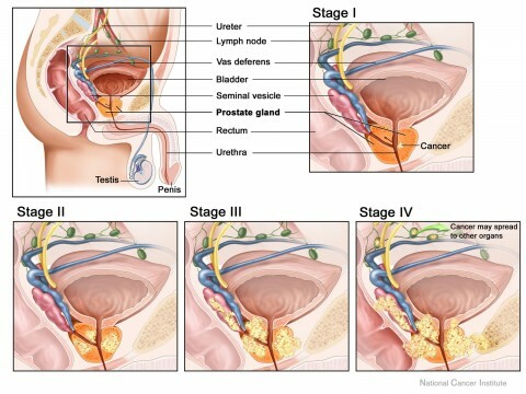 Etapas do adenoma da próstata