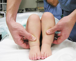 varias etapas de displasia de cadera en niños