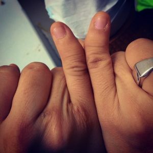Clinodactyly - congenitale anomalie van ontwikkeling van vingervingers