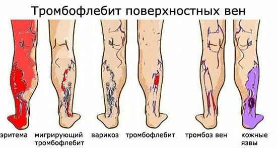 Thrombophlebitis of lower extremities: symptoms and treatment, photo
