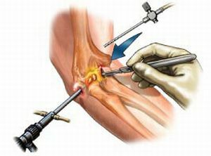 Arthroplasty of the elbow