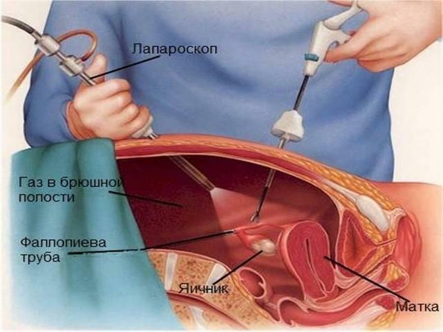 Laparoscopie du kyste ovarien
