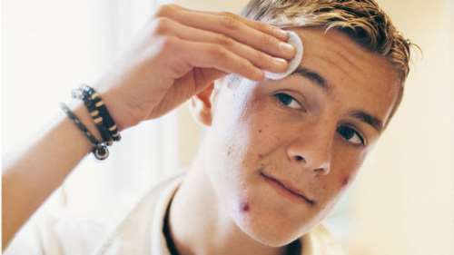 Tiener acne bij jongens dan te behandelen