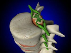 leziunea măduvei spinării