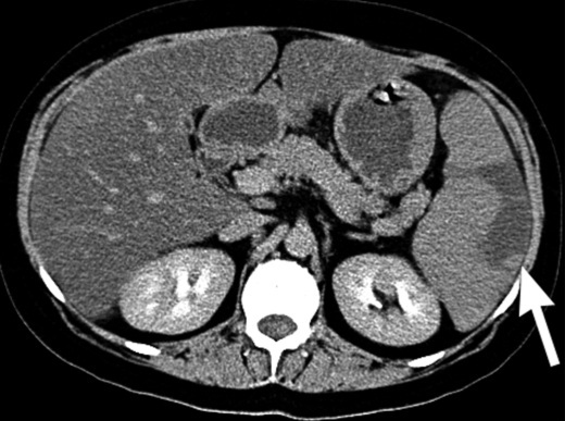 Splenectomy. Consequences for the body, as the operation is called, diet, rehabilitation