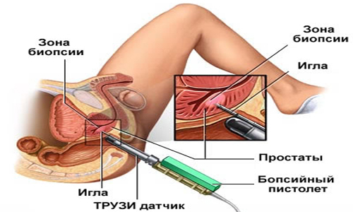 Ultrasonido transrectal de la próstata