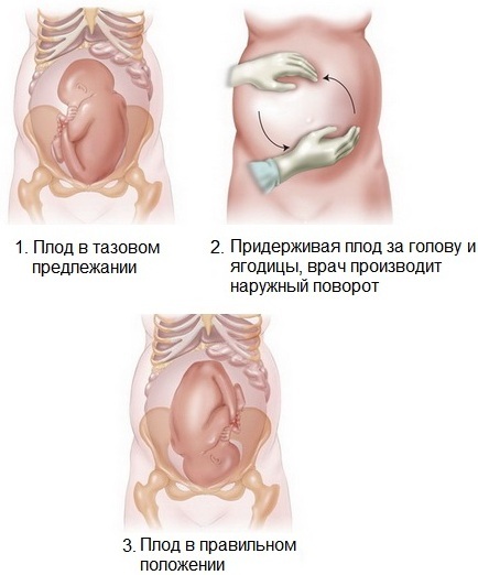 Breech presentasjon av fosteret ved 20-30-34 ukers svangerskap. Leveranse