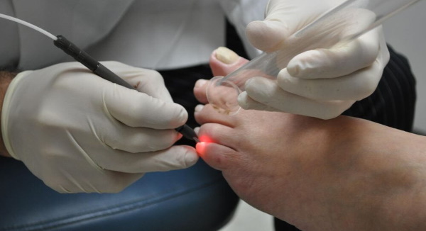 Correction laser des ongles des pieds, des ongles des pieds, des ongles incarnés. Qu'est-ce que c'est, comment font-ils, le prix