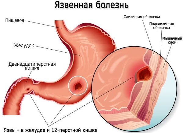 Duodenal ulcer. Symptoms and treatment of the causes. Folk remedies, diet, drugs