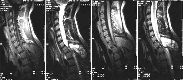 extramedullary spinal cord tumor