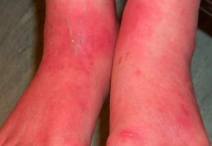 roodheid en ontsteking van de benen