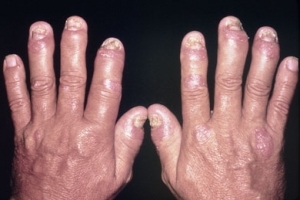 rheumatoid arthritis af hænderne