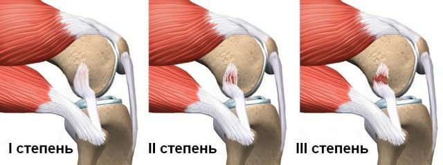 Distorsione dei legamenti dell'articolazione del ginocchio: primo soccorso e trattamento