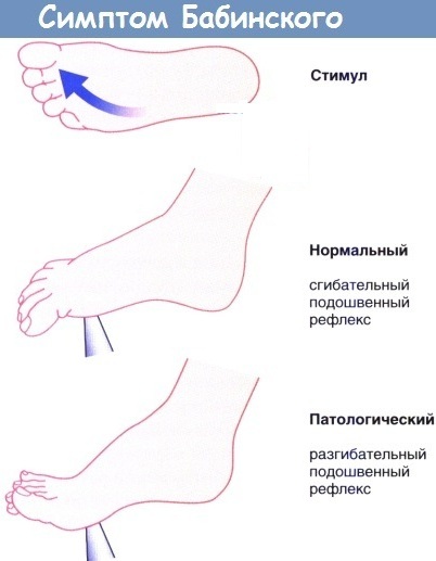Symptom (reflex) Babinsky. What is it from both sides, right, left, positive, negative