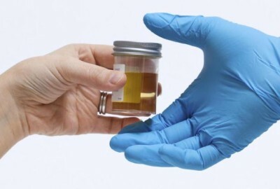 Diastasi delle urine: cos'è, la norma negli adulti, i bambini, come fare un'analisi
