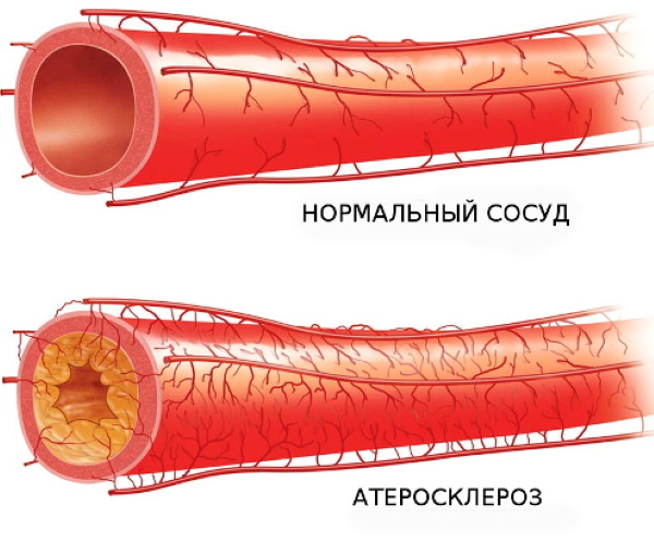 Češnjak s votkom za čišćenje krvnih žila. Recept sa fotografijom