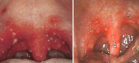 Herpes ondt i halsen: symptomer og behandling hos barn, foto
