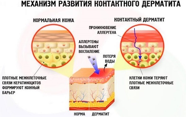 dermatitis treatment in adults and children. Ointments, creams or folk remedies