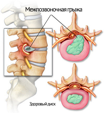 una hernia de una columna vertebral