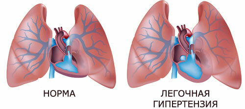 What is pulmonary hypertension