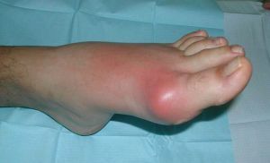 Inflamación de la articulación en la pierna