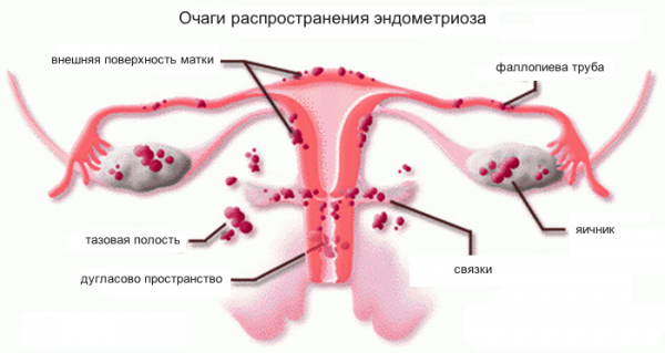 Locations of foci of endometriosis