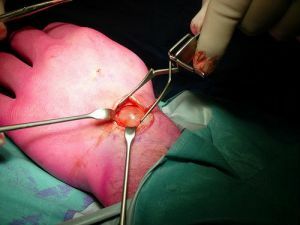 ganglion fjernelse kirurgi