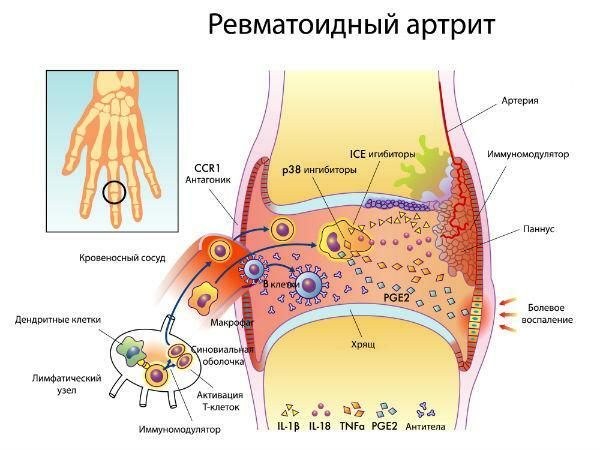Développement de la polyarthrite rhumatoïde