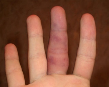Dislocazione di un dito