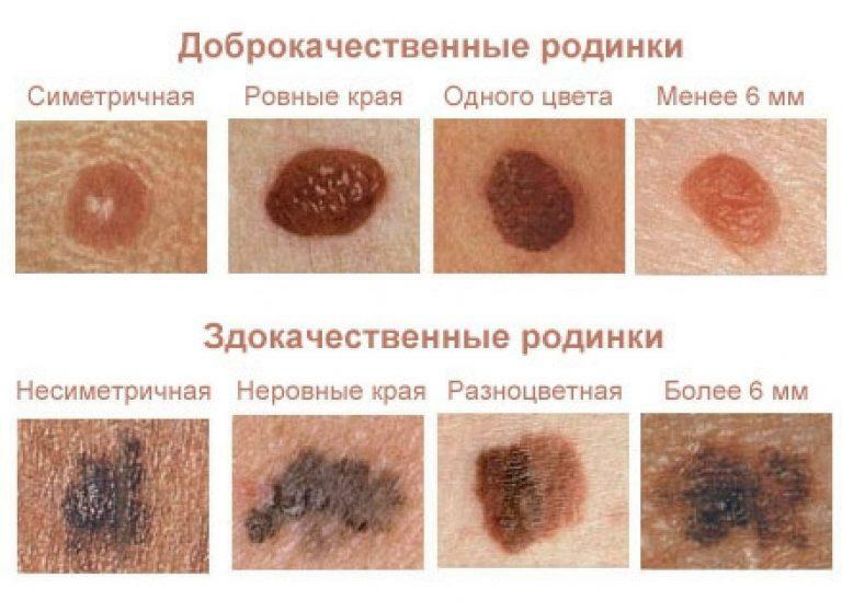 Utseendet av mol på kroppen av en voksen - årsakene, varianter, behandling
