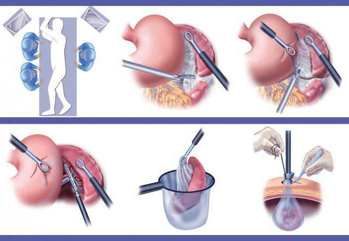 Splenectomy. Consequences for the body, as the operation is called, diet, rehabilitation