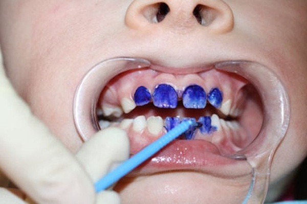 Bottle caries in children. Causes, symptoms, photos and treatment