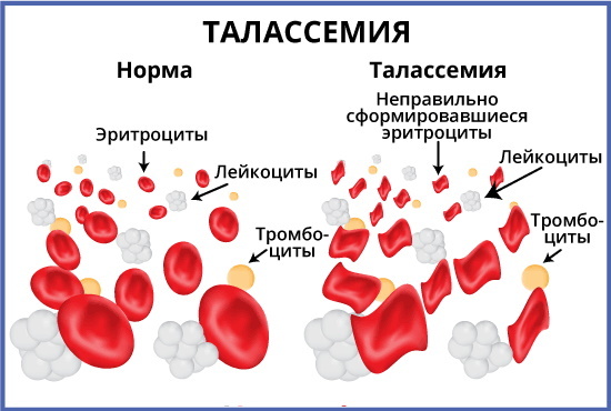 Anemia in women. Symptoms, causes, treatment