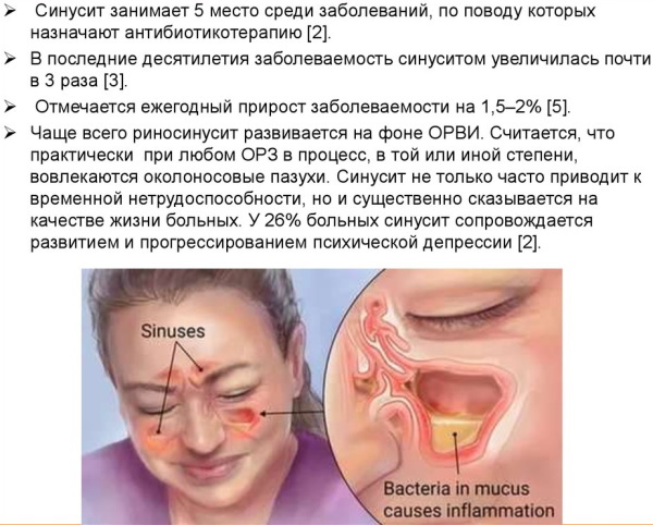 Acute rhinosinusitis in adults. Symptoms and Treatment