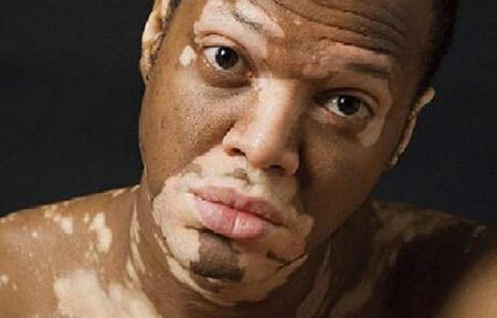 Príznaky vitiligy