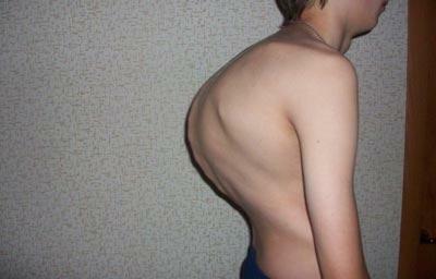 Korsning av ryggraden med tuberkulos