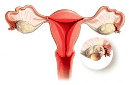 Ovarian cysten burst: symptom