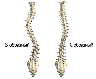 Typer af skoliose i rygsøjlen