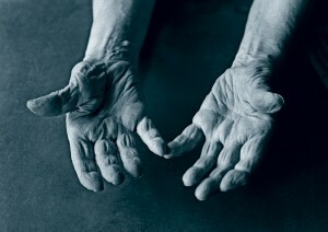 Artritis van de gewrichten van vingers op handen
