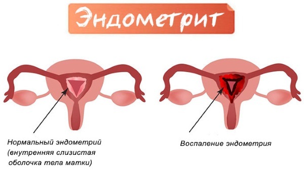RFE in gynecology. What is it, how is it carried out, testimony