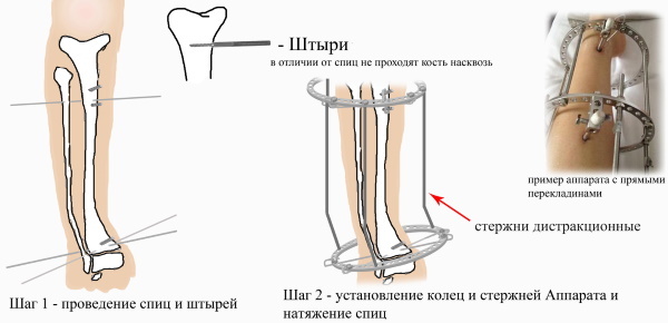 Ilizarov-apparaat op het been, arm, dij. Installatie, foto hoe, hoeveel te dragen, zorg voor