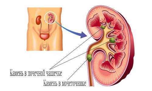 Microlits of the kidneys - how they manifest themselves and whether they need to be treated