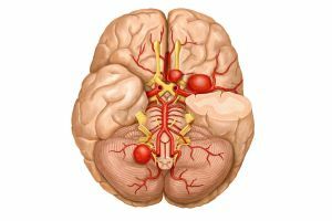 Smadzeņu vasospasma cēloņi, simptomi un ārstēšana