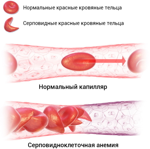Anemia. WHO hemoglobin classification in men, children, women