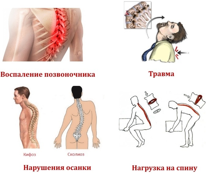 Hemangiolipoma espinal. Qué es, por qué es peligroso, tratamiento con remedios caseros, medicamentos para la columna torácica, cervical y lumbar